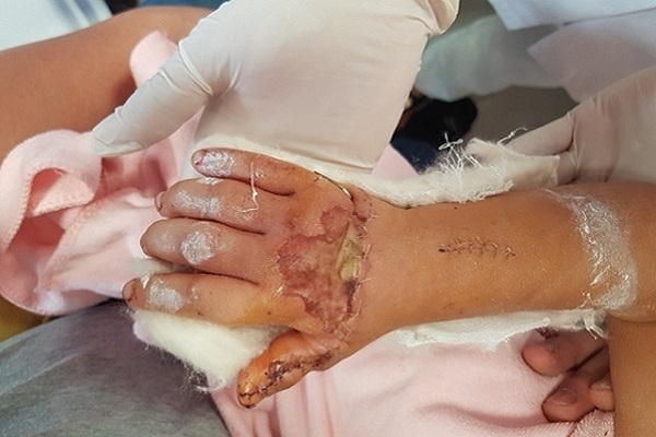 6h tiến hành phẫu thuật nối bàn tay đứt gần rời cho bé gái 3 tuổi