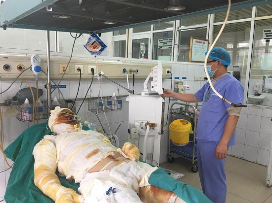 Bắc Giang: Đáng tiếc cắt bỏ ⅔ cánh tay do đốt củi sưởi ấm