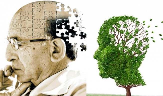 Bệnh Alzheimer – Nguyên nhân & Phương pháp điều trị bệnh