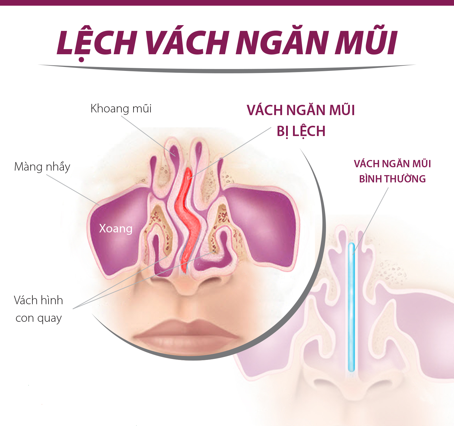Bệnh lệch vách ngăn mũi là gì? Những triệu chứng nhận biết bệnh