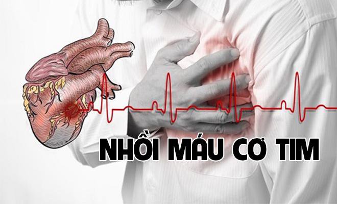 Bệnh nhồi máu cơ tim là gì? Tìm hiểu những nguyên nhân gây bệnh