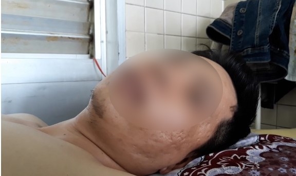 Bệnh viện Chợ Rẫy giải trình về vụ bệnh nhân bị gãy đốt sống ngực lại bị khoan chân