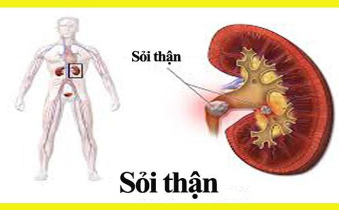Dấu hiệu và những biến chứng nguy hiểm của bệnh sỏi thận