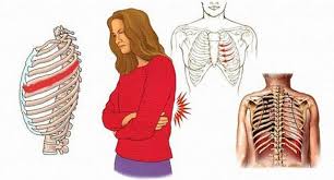 Đau thần kinh liên sườn – Triệu chứng & Nguyên nhân gây bệnh