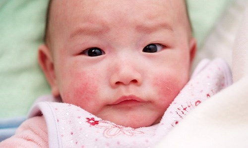 Dị ứng sữa và những dấu hiệu thường gặp khi mắc bệnh