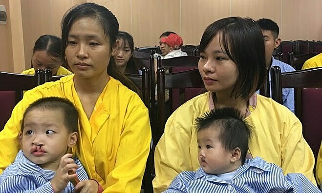 HÀ NỘI: Tiến hành phẫu thuật miễn phí cho trẻ hở môi