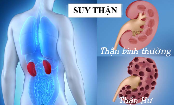 Hiểu như thế nào về bệnh lý suy thận mãn tính?