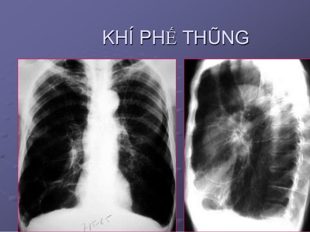 Khí phế thũng là bệnh gì?