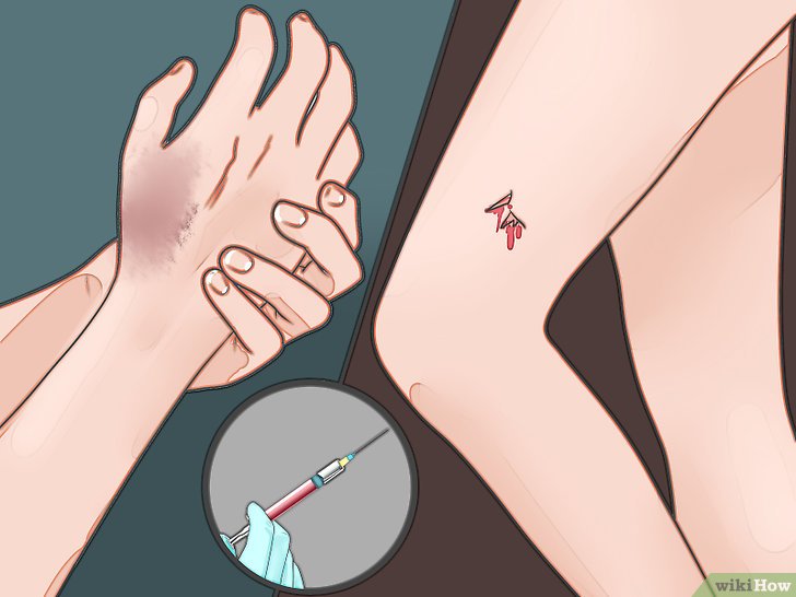 Nguyên nhân và những triệu chứng nhận biết bệnh uốn ván