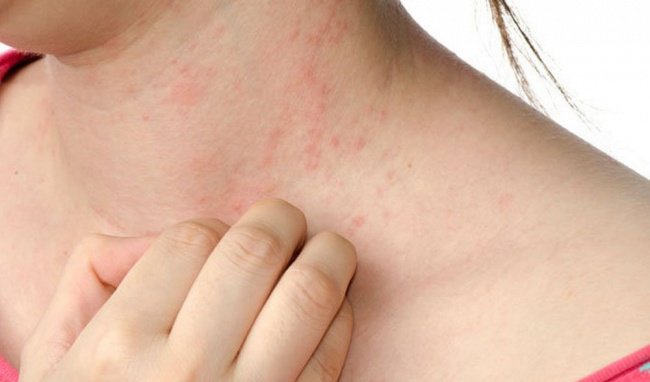 Những triệu chứng nhận biết bệnh sốt phát ban
