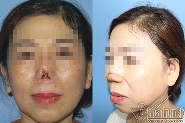 Phần mũi của quý bà Sài Gòn bị cụt lủn sau phẫu thuật nâng mũi