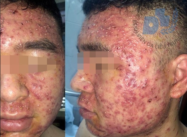 Sử dụng thuốc nam không rõ nguồn gốc, nam thanh niên 22 tuổi mụn mọc đầy mặt