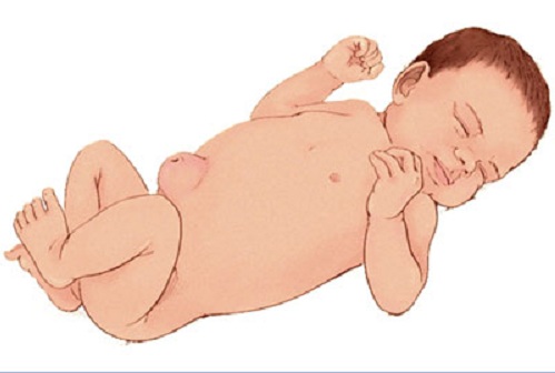 Thoát vị rốn là gì? Đâu là nguyên nhân gây bệnh?