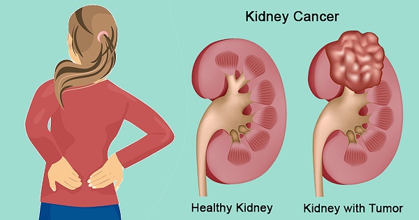 Tìm hiểu những thông tin liên quan đến bệnh ung thư thận