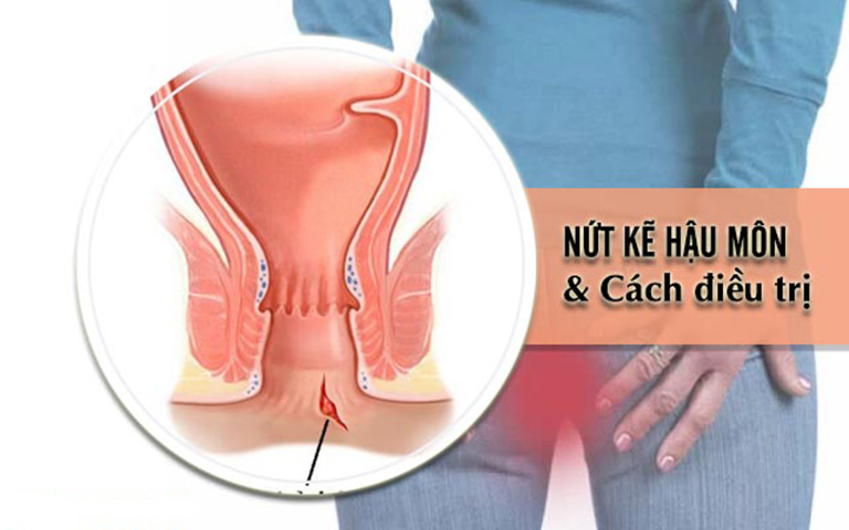 Triệu chứng & Nguyên nhân gây bệnh nứt kẽ hậu môn