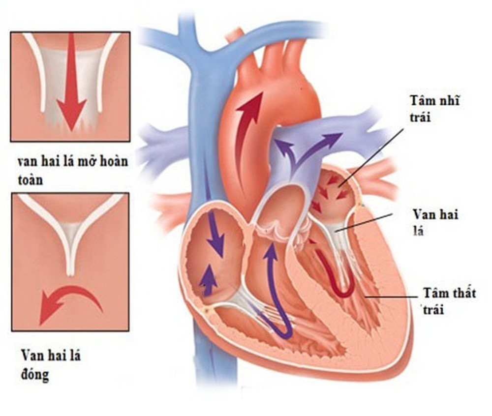 Triệu chứng và những nguyên nhân gây bệnh hở van hai lá