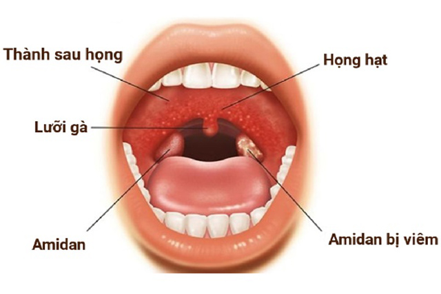 Viêm họng hạt là bệnh gì? Những triệu chứng nhận biết bệnh
