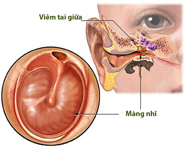 Viêm tai giữa là gì? Đây là những triệu chứng nhận biết bệnh?