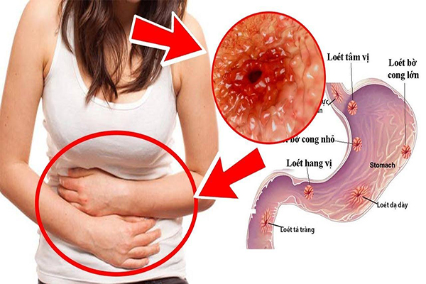 Bệnh đau dạ dày không do viêm loét có triệu chứng gì?
