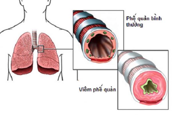 Bệnh viêm phế quản là gì? Nguyên nhân và triệu chứng của bệnh