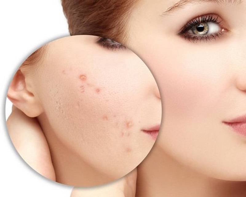 Chia sẻ các cách trị sẹo hiệu quả từ thiên nhiên an toàn