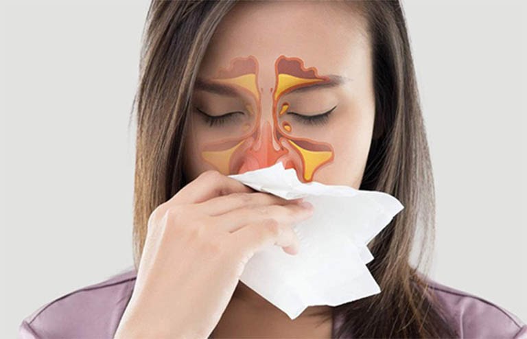 Cách trị viêm xoang mũi tại nhà hiệu quả không dùng thuốc