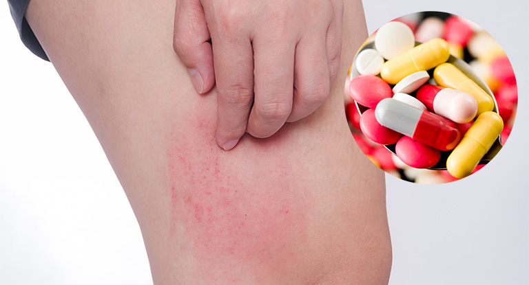 Dấu hiệu nhận biết bị dị ứng thuốc để có cách xử lý kịp thời
