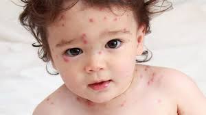 Mách mẹ cách điều trị khi trẻ bị bệnh thủy đậu