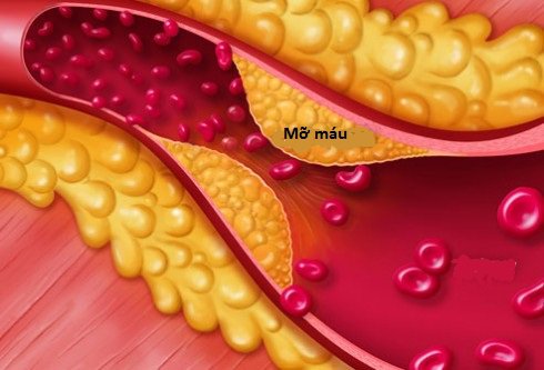 Mỡ máu cao thì sao? Những điều cần biết khi điều trị mỡ máu cao