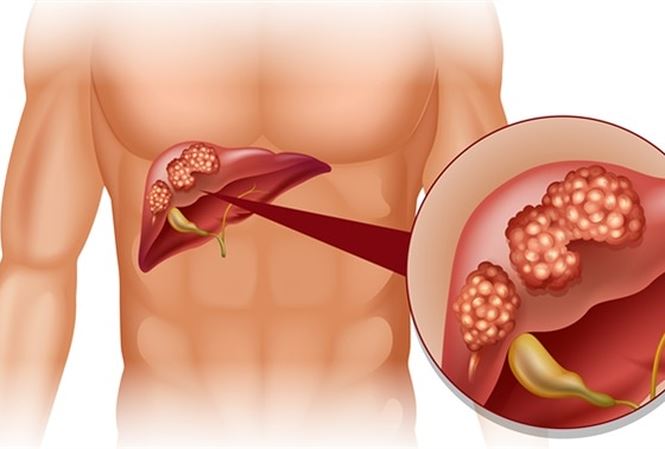 Những dấu hiệu nhận biết cơ bản nhất của bệnh ung thư gan