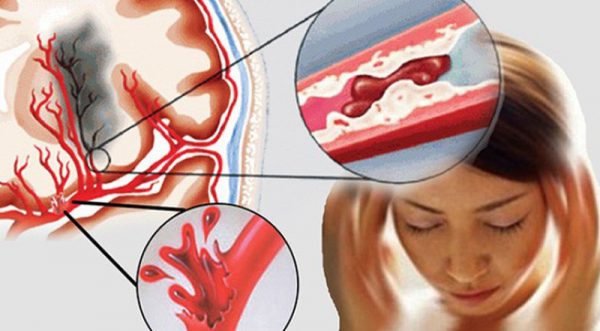 Những phương pháp phòng ngừa liệt do tai biến mạch máu não hiệu quả