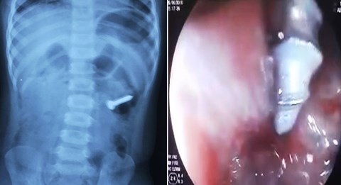 Suýt mất mạng vì nuốt phải đinh ốc xoắn dài 3cm vào bụng