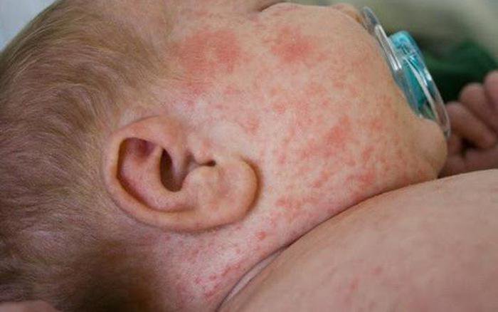 Triệu chứng sốt xuất huyết ở trẻ em và cách điều trị