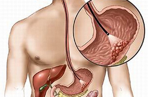 Ung thư dạ dày và những thói quen dễ mắc bệnh