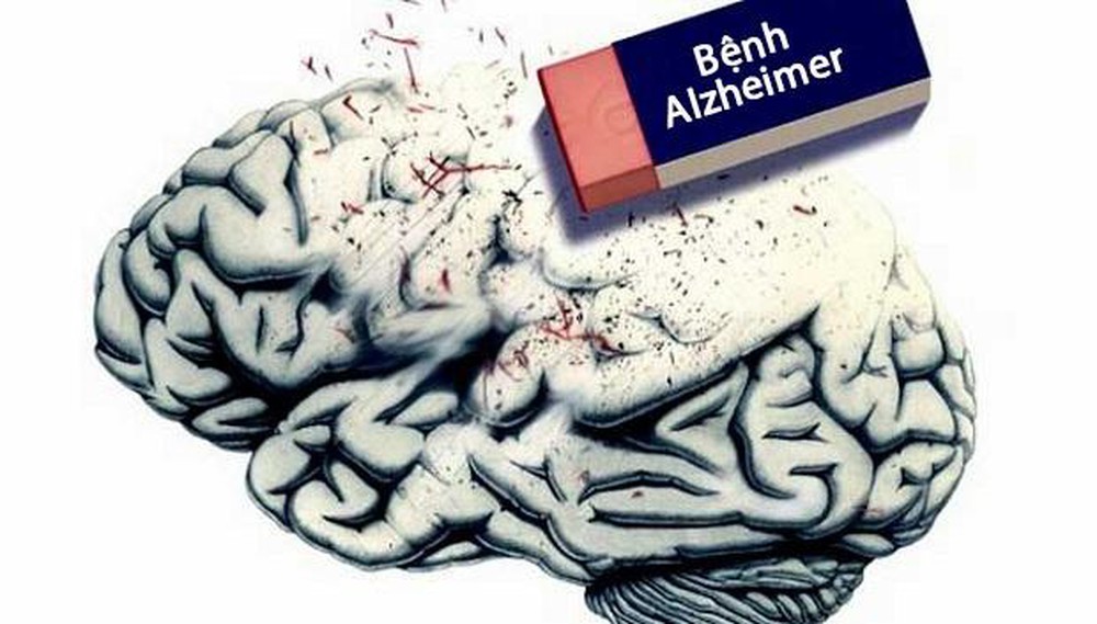 Bệnh Alzheimer - Nguyên Nhân & Phương Pháp điều Trị Bệnh