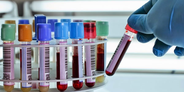Albumin máu - Ý nghĩa của việc xét nghiệm Albumin trong máu 2