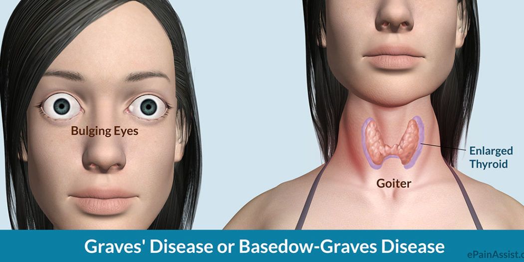 Tổng hợp thông tin liên quan đến bệnh Basedow 1