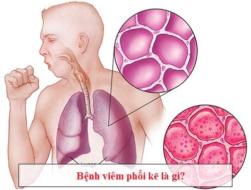 Bệnh phổi kẽ là gì? Tìm hiểu nguyên nhân và triệu chứng gây bệnh 1
