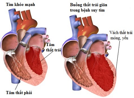 Hội chứng suy tim trái là gì? Nguyên nhân và triệu chứng nhận biết bệnh 1