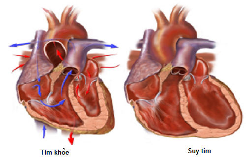 Hội chứng suy tim trái là gì? Nguyên nhân và triệu chứng nhận biết bệnh 2