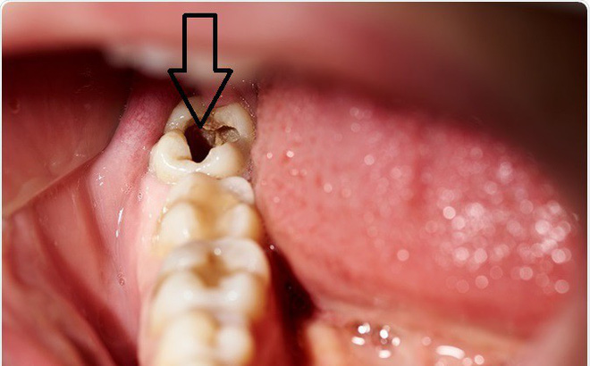 Tổng hợp những thực phẩm có khả năng hạn chế sâu răng cao 1