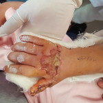 6h tiến hành phẫu thuật nối bàn tay đứt gần rời cho bé gái 3 tuổi