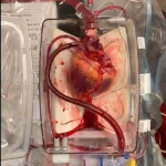 Bác sĩ hồi sinh được trái tim người chết, đột phá mới của nền Y học trong ghép tạng