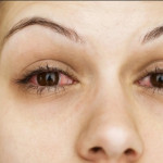 Bệnh khô mắt nên bổ sung thêm Vitamin A
