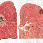 Bệnh phổi kẽ là gì? Tìm hiểu nguyên nhân và triệu chứng gây bệnh