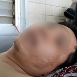 Bệnh viện Chợ Rẫy giải trình về vụ bệnh nhân bị gãy đốt sống ngực lại bị khoan chân