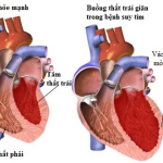 Hội chứng suy tim trái là gì? Nguyên nhân và triệu chứng nhận biết bệnh
