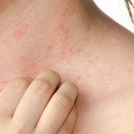 Những triệu chứng nhận biết bệnh sốt phát ban