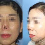 Phần mũi của quý bà Sài Gòn bị cụt lủn sau phẫu thuật nâng mũi