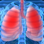 Thông tin về triệu chứng và nguyên nhân gây bệnh phù phổi cấp